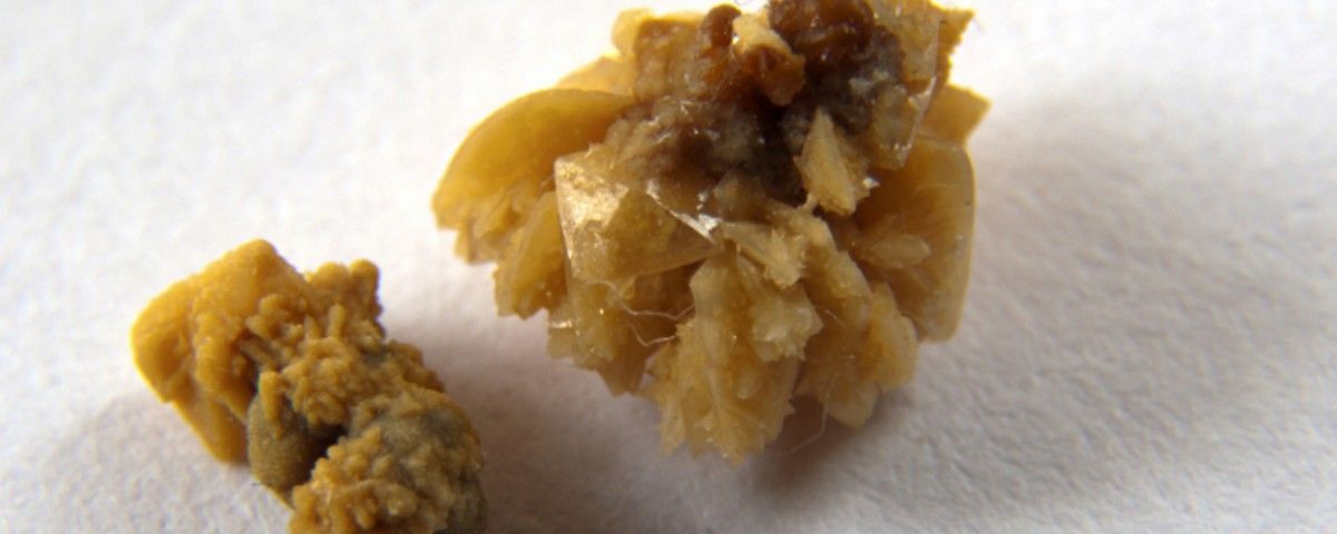 SOS! Piedra en el riñón | Frenar el envejecimiento es posible